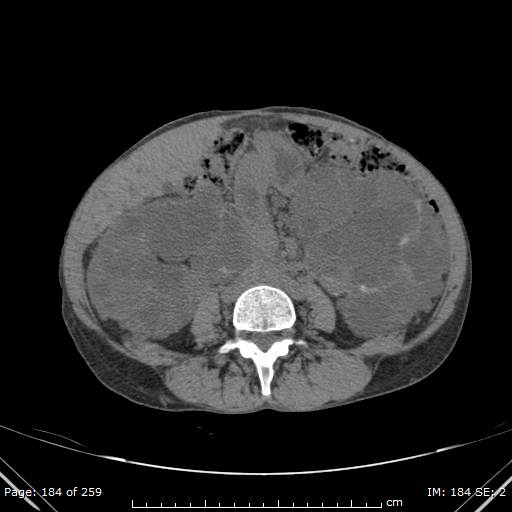Autosomal dominant polycystic kidney disease (Radiopaedia 44122-47684 Axial non-contrast 66).jpg