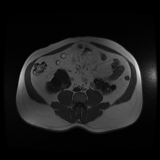 Autosomal dominant polycystic kidney disease (Radiopaedia 50259-55611 Axial 2D Dual Echo 66).jpg