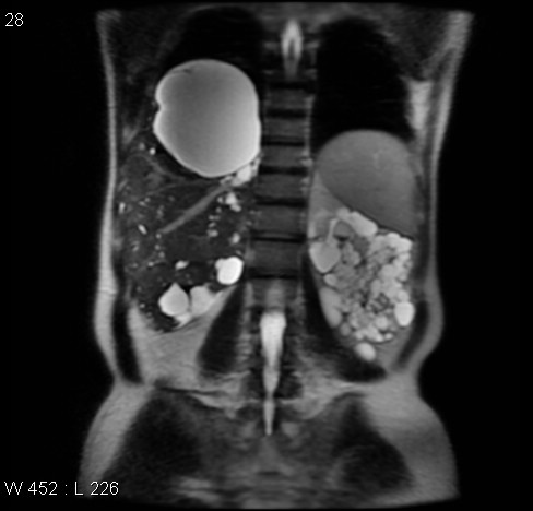File:Autosomal dominant polycystic kidney disease (Radiopaedia 5202-6969 Coronal T2 11).jpg