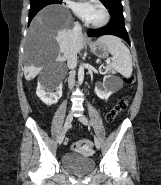 Autosomal dominant polycystic kidney disease (Radiopaedia 57124-64017 B 42).jpg