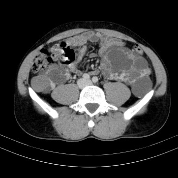 Autosomal dominant polycystic kidney disease (Radiopaedia 66349-75582 B 66).jpg