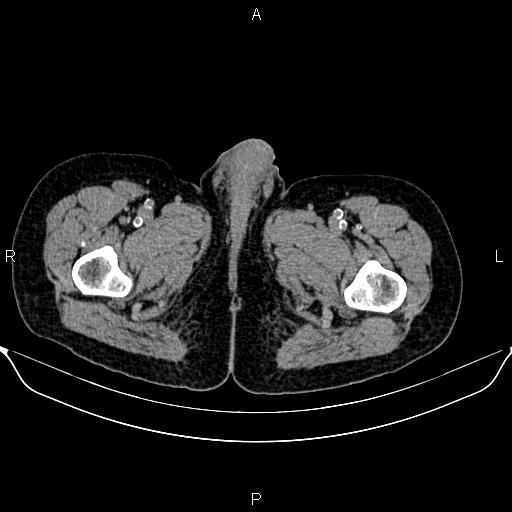 Autosomal dominant polycystic kidney disease (Radiopaedia 87830-104287 Axial non-contrast 62).jpg
