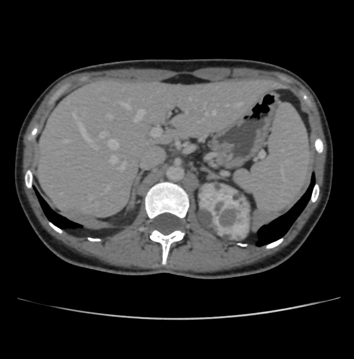 Autosomal dominant polycystic kidney disease - early onset (Radiopaedia 40734-43387 A 11).jpg