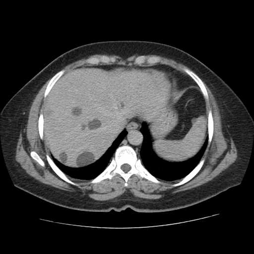File:Autosomal dominant polycystic kidney disease with hepatic involvement (Radiopaedia 32693-33662 C 9).jpg