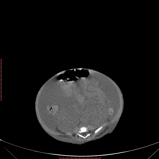 Autosomal recessive polycystic kidney disease associated with Caroli disease (Radiopaedia 61932-69984 Axial non-contrast 260).jpg