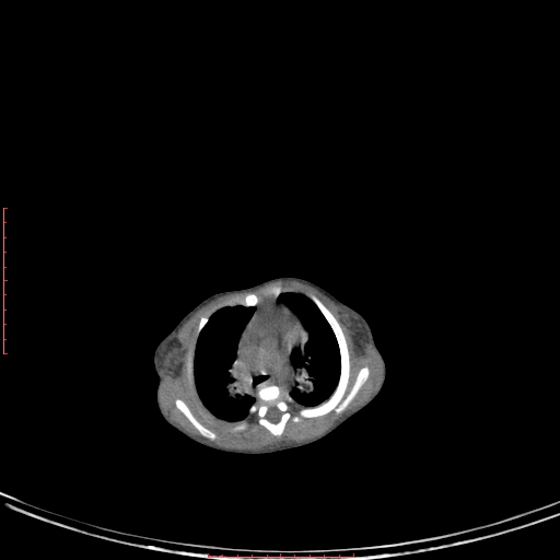 Autosomal recessive polycystic kidney disease associated with Caroli disease (Radiopaedia 61932-69984 Axial non-contrast 39).jpg