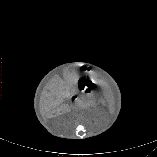 Autosomal recessive polycystic kidney disease associated with Caroli disease (Radiopaedia 61932-69984 B 177).jpg