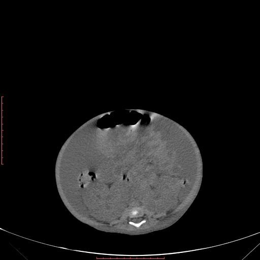 Autosomal recessive polycystic kidney disease associated with Caroli disease (Radiopaedia 61932-69984 B 244).jpg