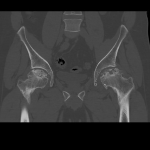 File:Avascular necrosis of the hip (Radiopaedia 61503-69467 Coronal bone window 14).jpg
