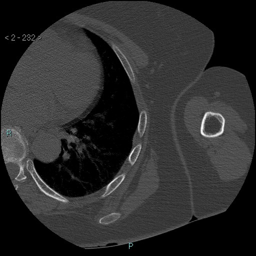Avascular necrosis of the shoulder - Cruess stage I (Radiopaedia 77674-89887 Axial bone window 58).jpg