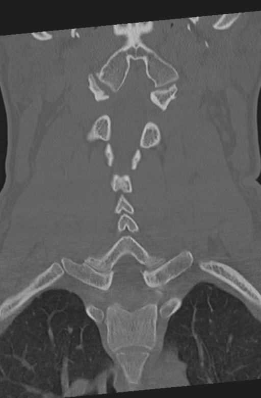Axis peg fracture (type 3) and atlas lateral mass (type 4) fracture (Radiopaedia 37474-39324 Coronal bone window 28).png