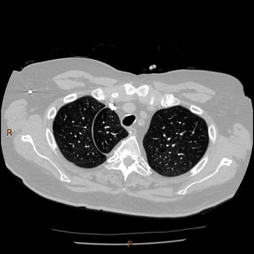 Azygos lobe (Radiopaedia 40161-42821 Axial lung window 6).jpg