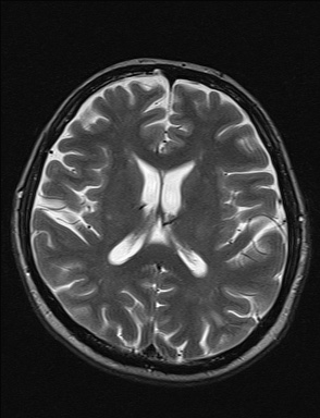 File:Balo concentric sclerosis (Radiopaedia 50458-55940 Axial T2 19).jpg