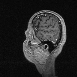 Balo concentric sclerosis (Radiopaedia 50458-55940 Sagittal T1 C+ 24).jpg