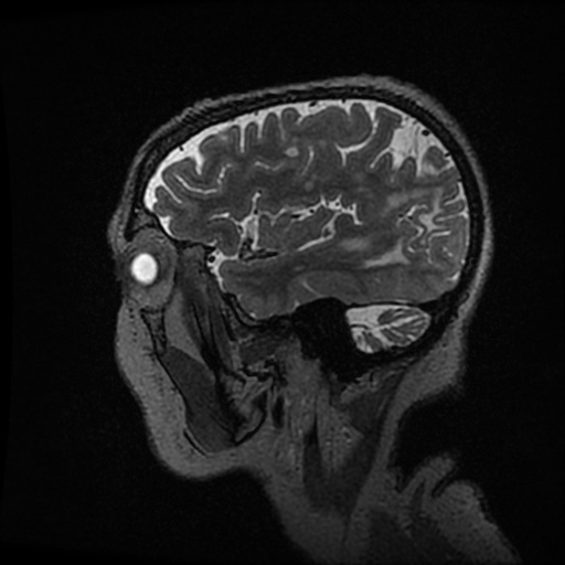 Balo concentric sclerosis (Radiopaedia 53875-59982 Sagittal 3D FSE 58).jpg