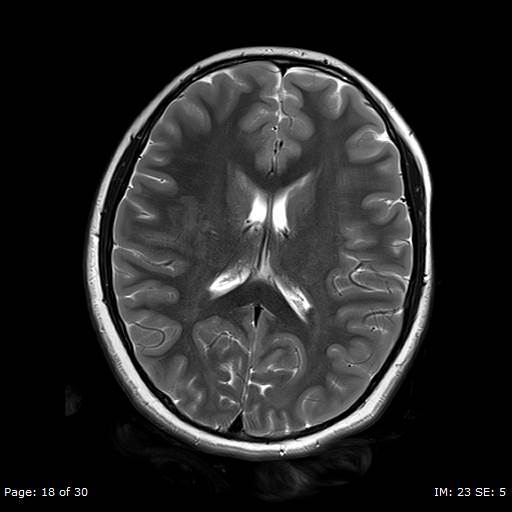 Balo concentric sclerosis (Radiopaedia 61637-69636 I 131).jpg