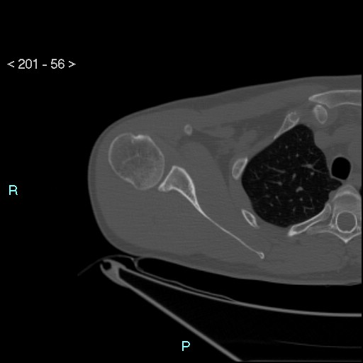 Bankart lesion with glenoid bone defect - assessment TC with PICO method (Radiopaedia 42855-93901 Axial bone window 55).jpg