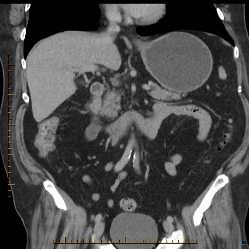 File:Bariatric balloon causing gastric outlet obstruction (Radiopaedia 54449-60672 B 29).jpg