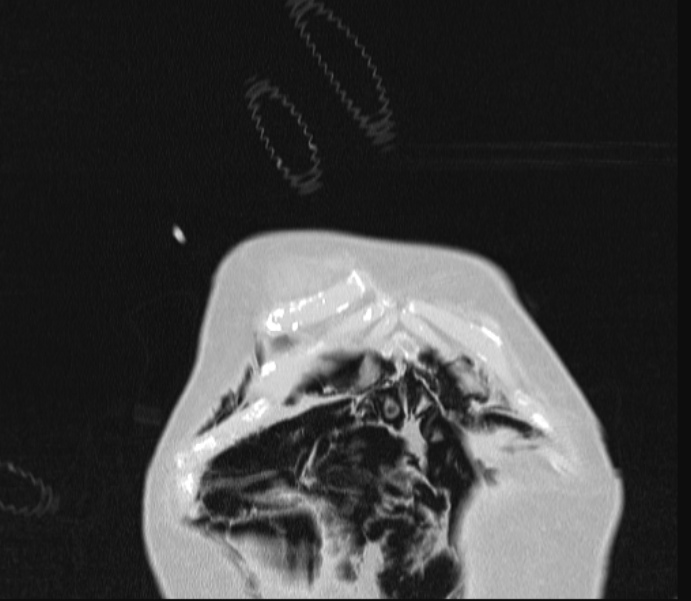 Barotrauma due to mechanical ventilation (Radiopaedia 28079-28336 Coronal lung window 8).jpg