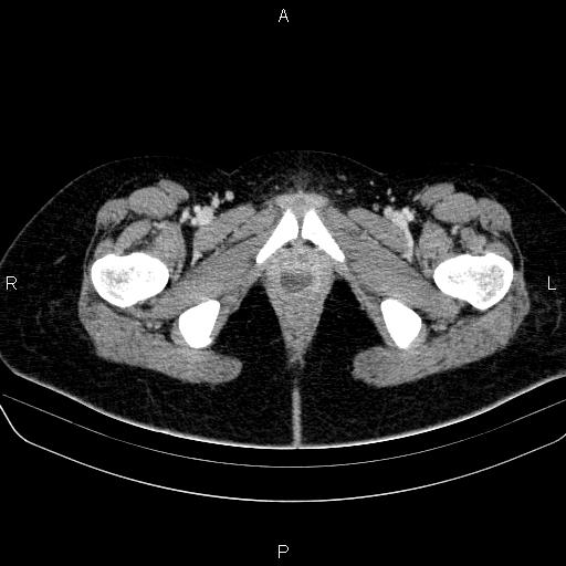 File:Bartholin gland cyst (Radiopaedia 62635-70930 Axial Post contrast 86).jpg