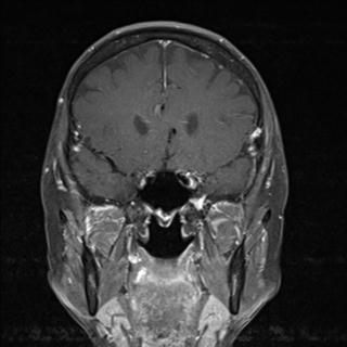 File:Base of skull chondrosarcoma (Radiopaedia 30410-31070 G 1).jpg