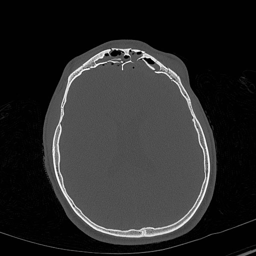File:Base of skull fracture with bilateral Le Fort fractures (Radiopaedia 47094-51638 Axial bone window 57).jpg