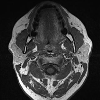 File:Base of tongue squamous cell carcinoma (Radiopaedia 31174-31884 Axial T1 25).jpg