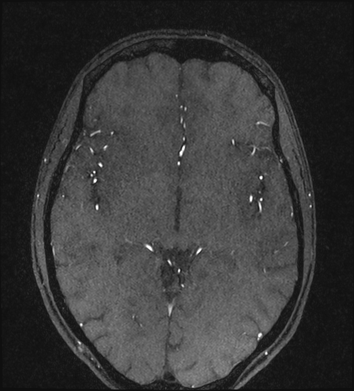 Basilar artery perforator aneurysm (Radiopaedia 82455-97733 Axial MRA 129).jpg