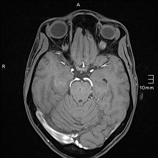 Basilar artery perforator aneurysm (Radiopaedia 82455-99523 F 51).jpg