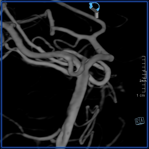 Basilar artery perforator aneurysm (Radiopaedia 82455-99524 3D Left VA 54).jpg