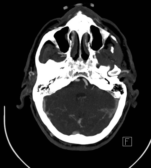 Basilar artery thrombosis (Radiopaedia 26986-27163 A 26).jpg