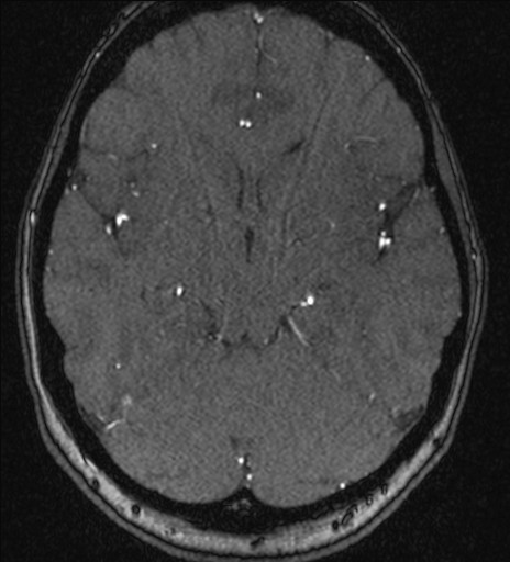 File:Basilar tip aneurysm (Radiopaedia 26504-26632 MRA 102).jpg