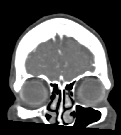 Basilar tip aneurysm with coiling (Radiopaedia 53912-60086 B 13).jpg