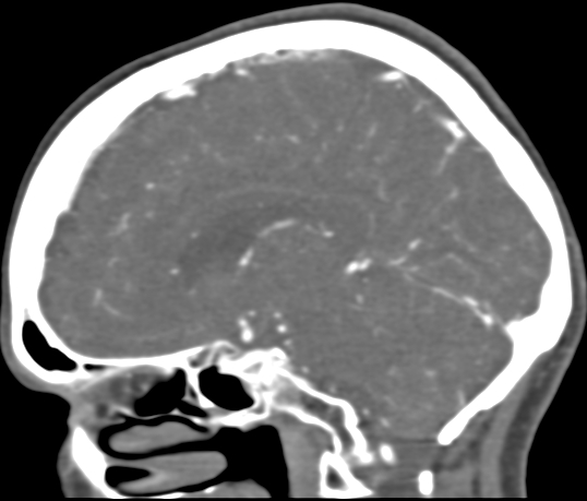 File:Basilar tip aneurysm with coiling (Radiopaedia 53912-60086 C 75).jpg