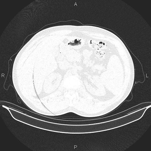 File:Beam hardening and ring artifacts (Radiopaedia 85323-100915 Axial lung window 78).jpg
