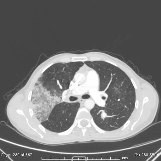 Behçet disease (Radiopaedia 44247-47889 Axial lung window 35).jpg