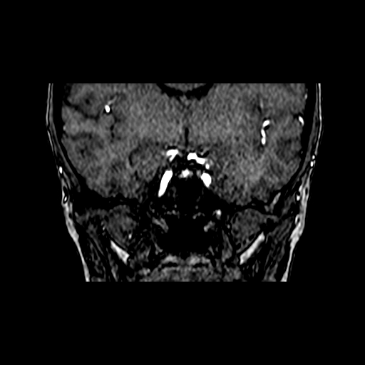 Berry aneurysm of the terminal internal carotid artery (Radiopaedia 88286-104918 Coronal TOF 43).jpg