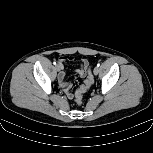 Bilateral accessory renal arteries with mild pelvi-ureteric junction (PUJ) obstruction (Radiopaedia 66357-75596 A 62).jpg