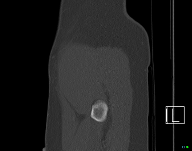 Bilateral acetabular fractures (Radiopaedia 79272-92308 Sagittal bone window 86).jpg