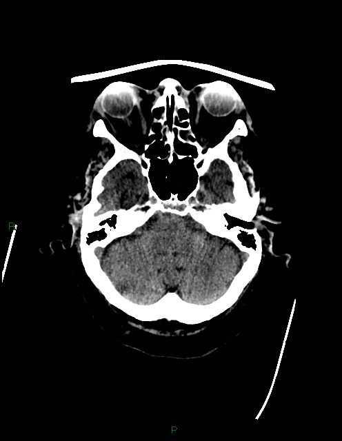 Bilateral acute middle cerebral artery territory infarcts (Radiopaedia 77319-89401 Axial non-contrast 18).jpg
