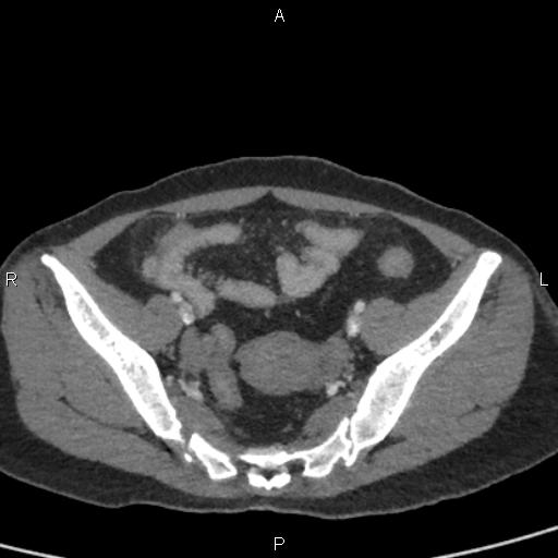 File:Bilateral adrenal gland hyperenhancement in pancreatitis (Radiopaedia 86642-102753 E 92).jpg