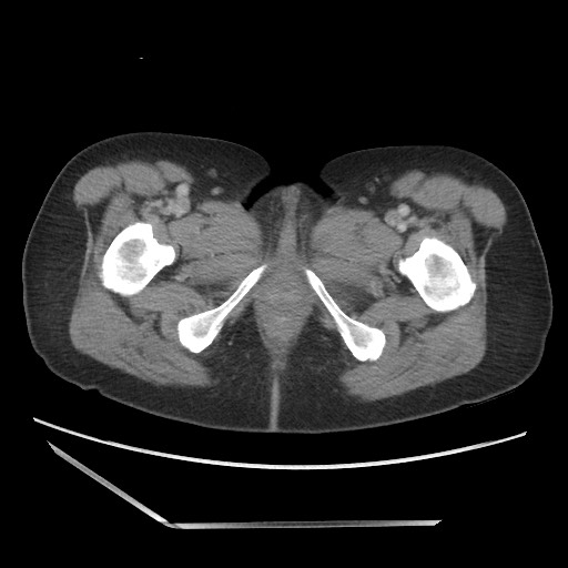 File:Bilateral adrenal granulocytic sarcomas (chloromas) (Radiopaedia 78375-91007 Axial 118).jpg