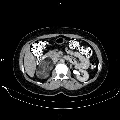 Bilateral adrenal myelolipoma (Radiopaedia 63058-71535 Axial C+ delayed 46).jpg