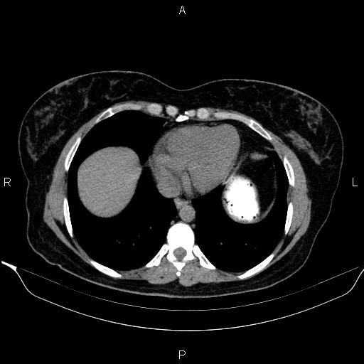 Bilateral adrenal myelolipoma (Radiopaedia 63058-71535 Axial non-contrast 6).jpg