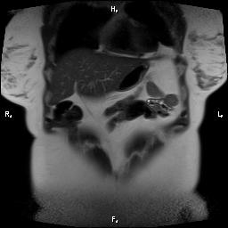File:Bilateral adrenal myelolipoma (Radiopaedia 63058-71537 Coronal T2 28).jpg