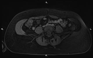 Bilateral adrenal myelolipoma (Radiopaedia 63058-71537 G 77).jpg