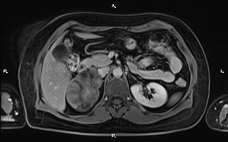 File:Bilateral adrenal myelolipoma (Radiopaedia 63058-71537 H 41).jpg
