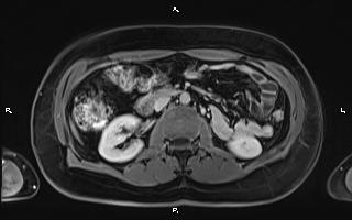File:Bilateral adrenal myelolipoma (Radiopaedia 63058-71537 H 53).jpg