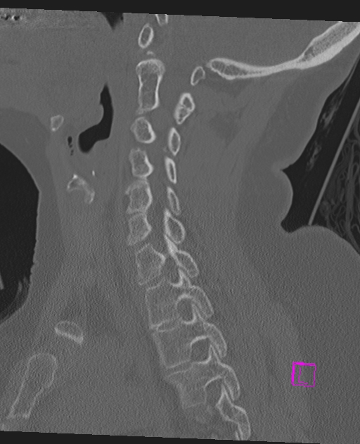 Bilateral atlanto-occipital assimilation (Radiopaedia 28350-28603 Sagittal bone window 33).jpg