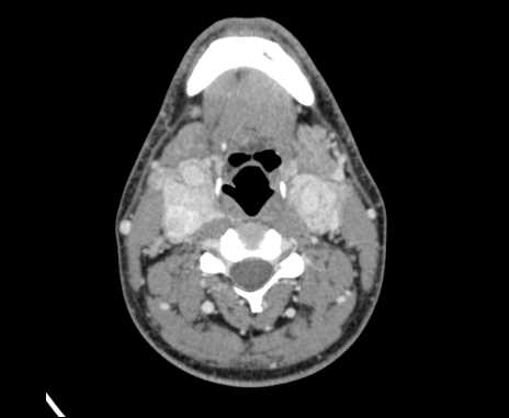 File:Bilateral carotid body tumors (Radiopaedia 61841-69870 Axial Post contrast 52).jpg